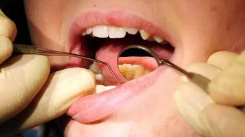 A close up of a mouth, which is open. A dentist, wearing white protective gloves, holds a mirror and another tool to inspect the patients' teeth.